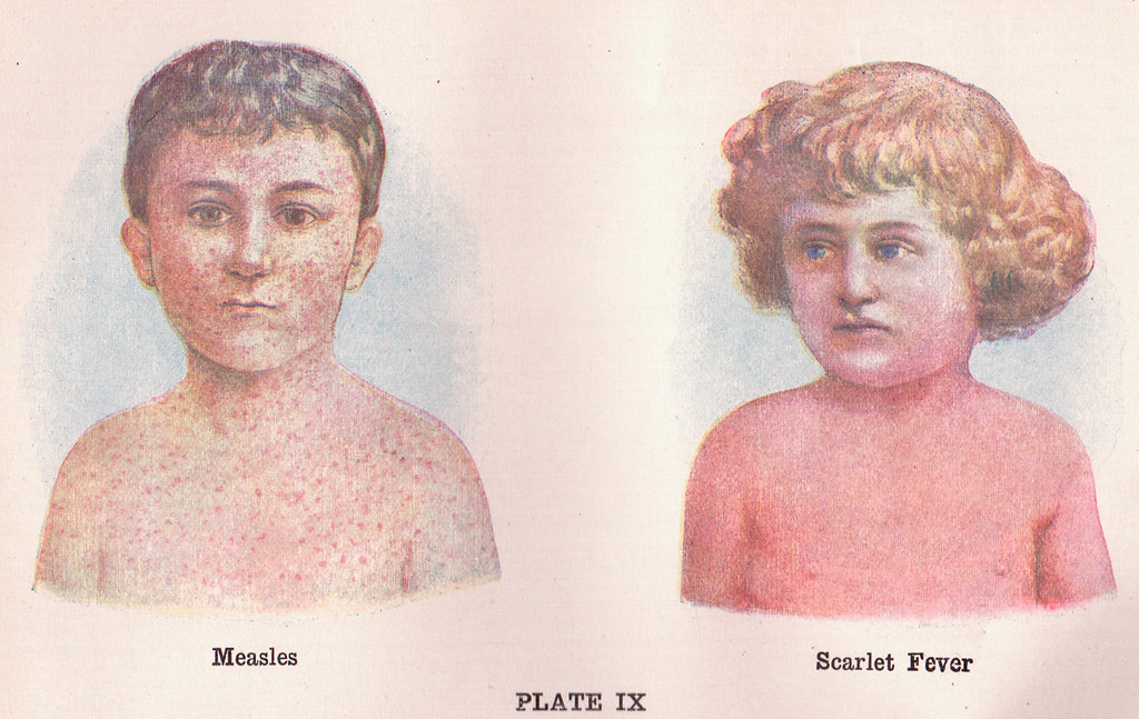 Measles and Scarlet Fever